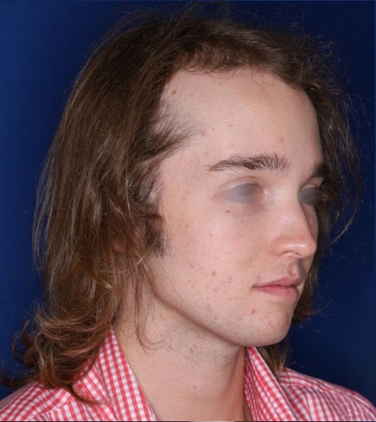 25 year old male about 2 years following 1,500 graft transplant