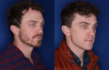 33 yrs old male patient 1+ year post op 2,000 graphs to restore frontal hairline & mid scalp
