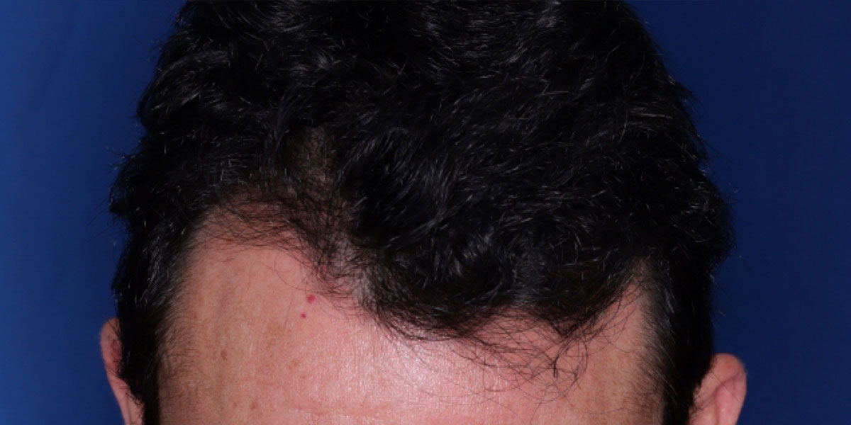 after the hair transplant