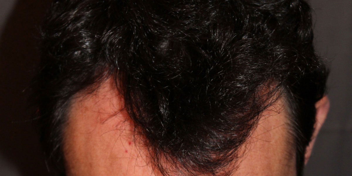 before the hair transplant