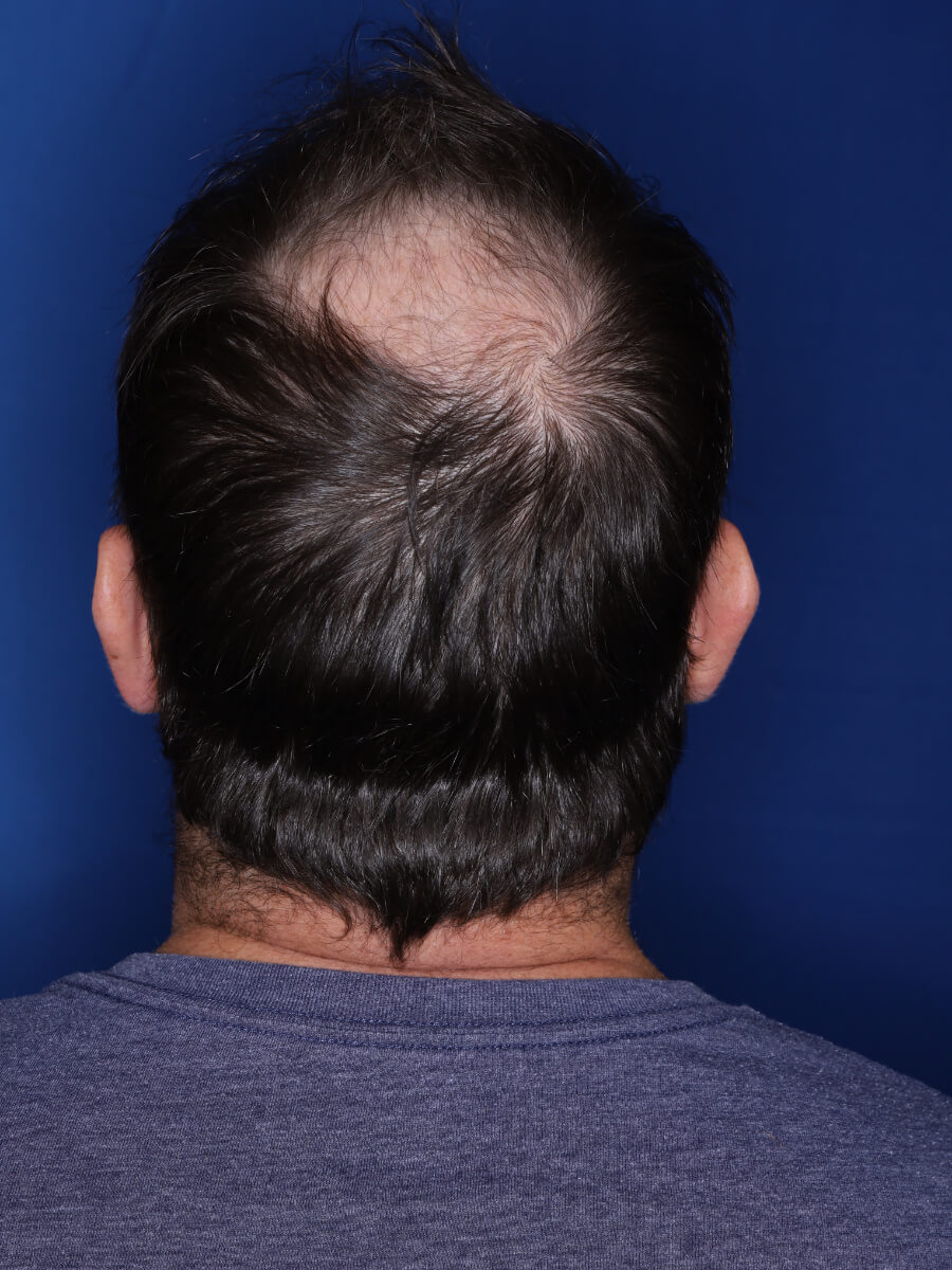 45 year old male 1 year post op from 3000 grafts throughout the entire scalp.