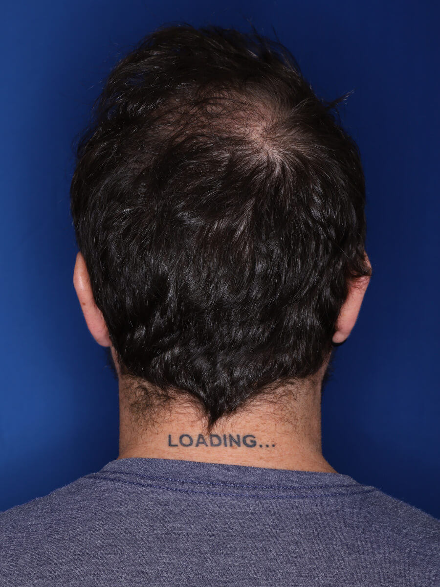 45 year old male 1 year post op from 3000 grafts throughout the entire scalp.