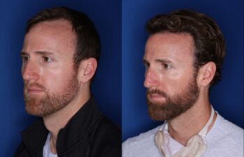 36 year old 8 months following 2500 grafts to frontal, temporal hair line