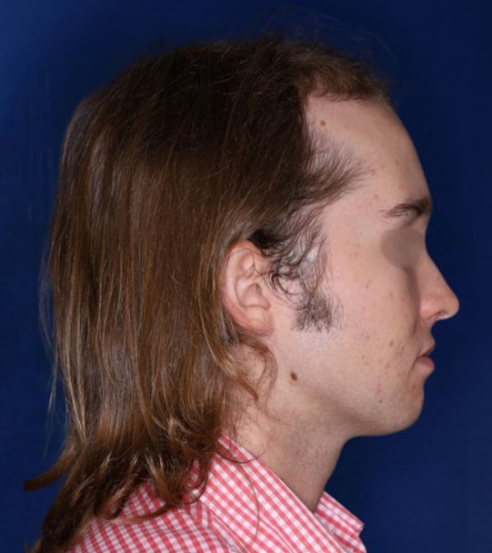 25 year old male about 2 years following 1,500 graft transplant