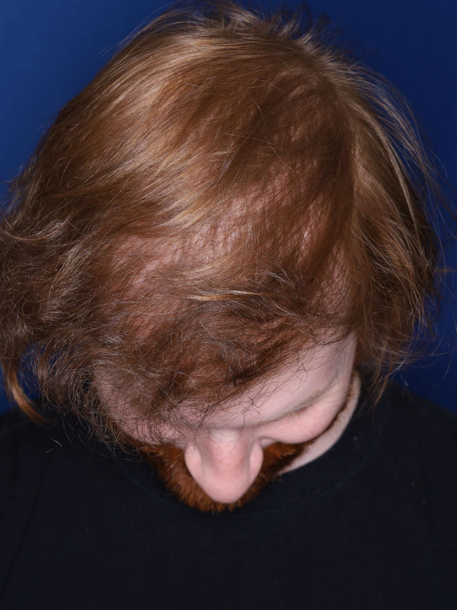 27 year old male 13 months following a 3000 graft hair transplant - after