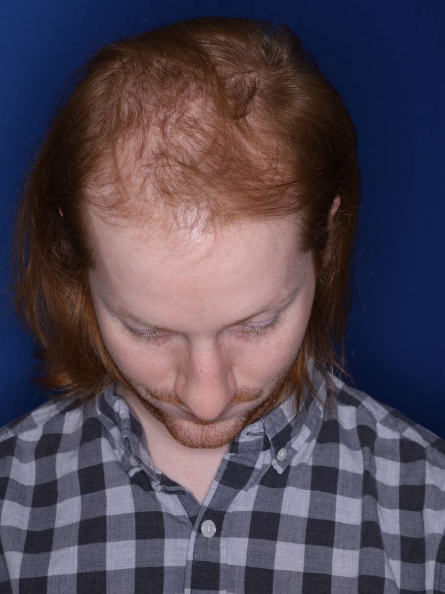27 year old male 13 months following a 3000 graft hair transplant - before