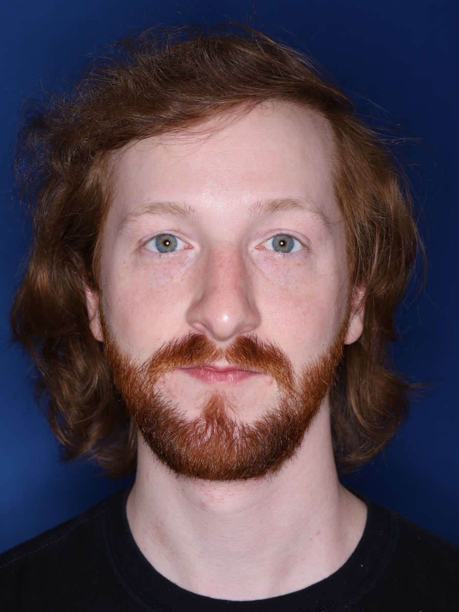 27 year old male 13 months following a 3000 graft hair transplant - after