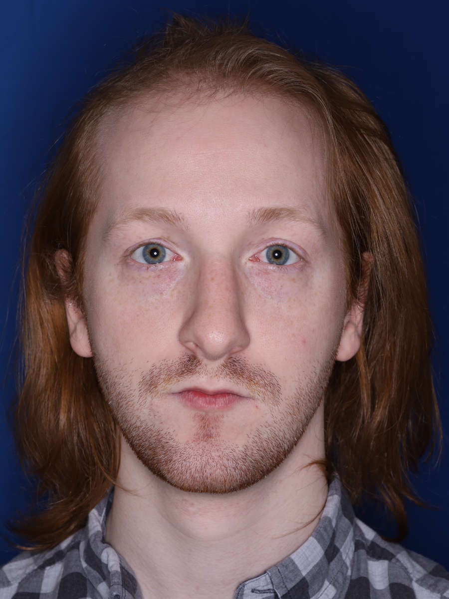 27 year old male 13 months following a 3000 graft hair transplant - before
