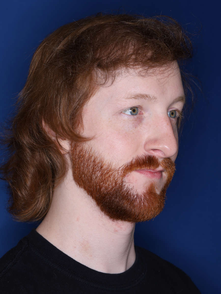 27 year old male 13 months following a 3000 graft hair transplant - after