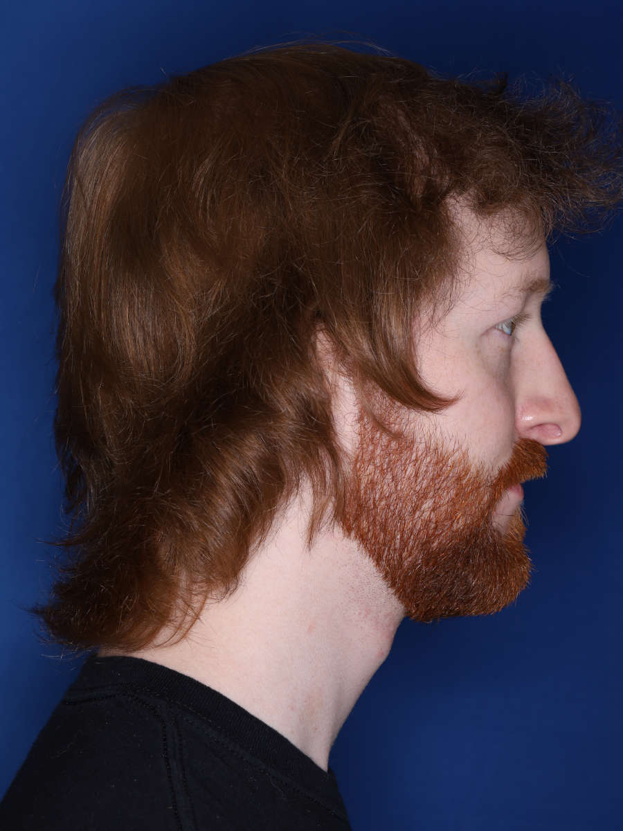 27 year old male 13 months following a 3000 graft hair transplant - after