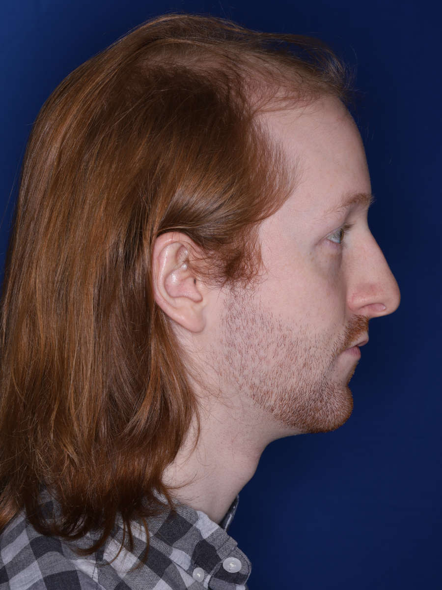 27 year old male 13 months following a 3000 graft hair transplant - before