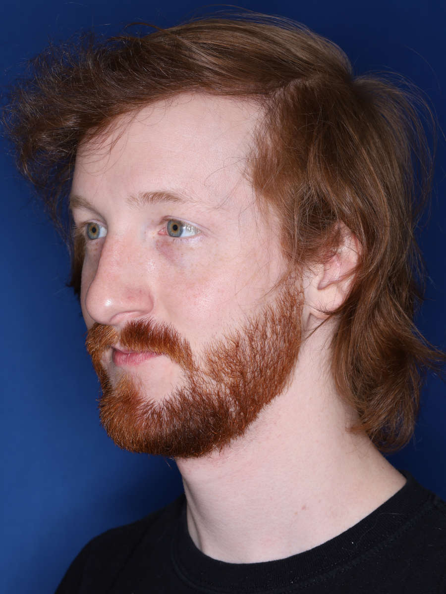 27 year old male 13 months following a 3000 graft hair transplant - after