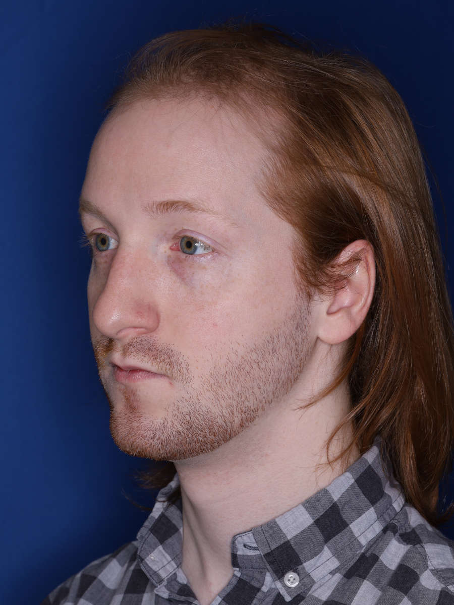 27 year old male 13 months following a 3000 graft hair transplant - before