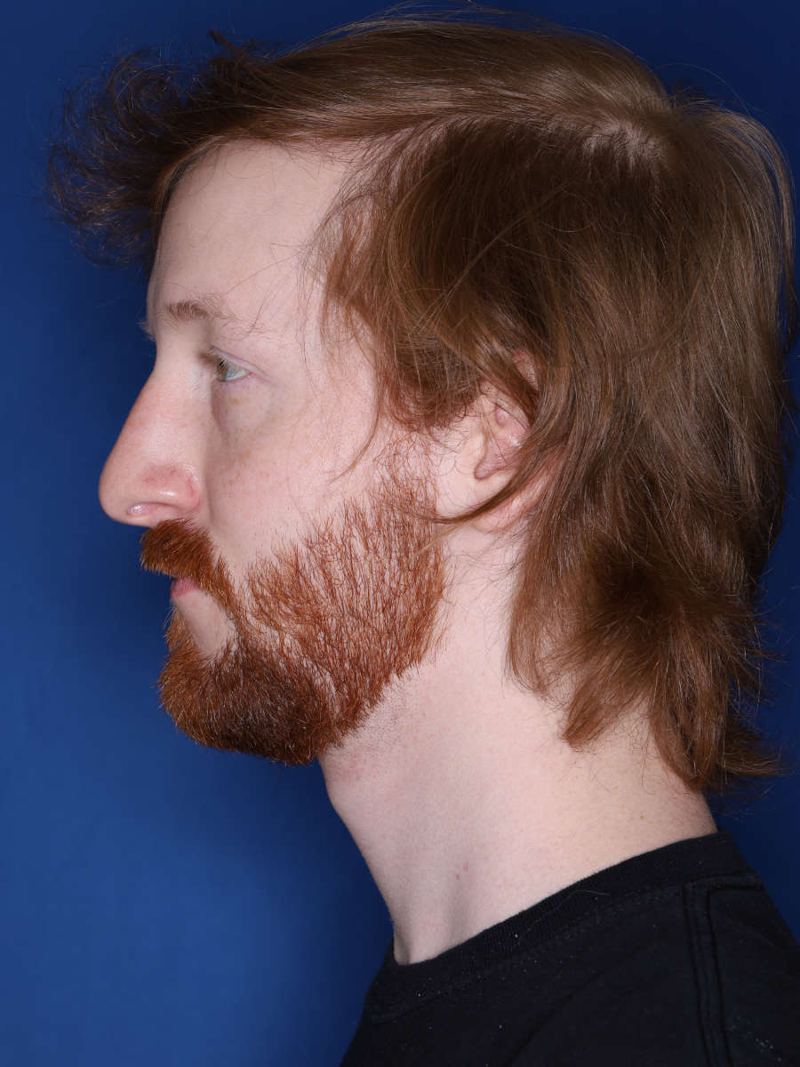 27 year old male 13 months following a 3000 graft hair transplant - a