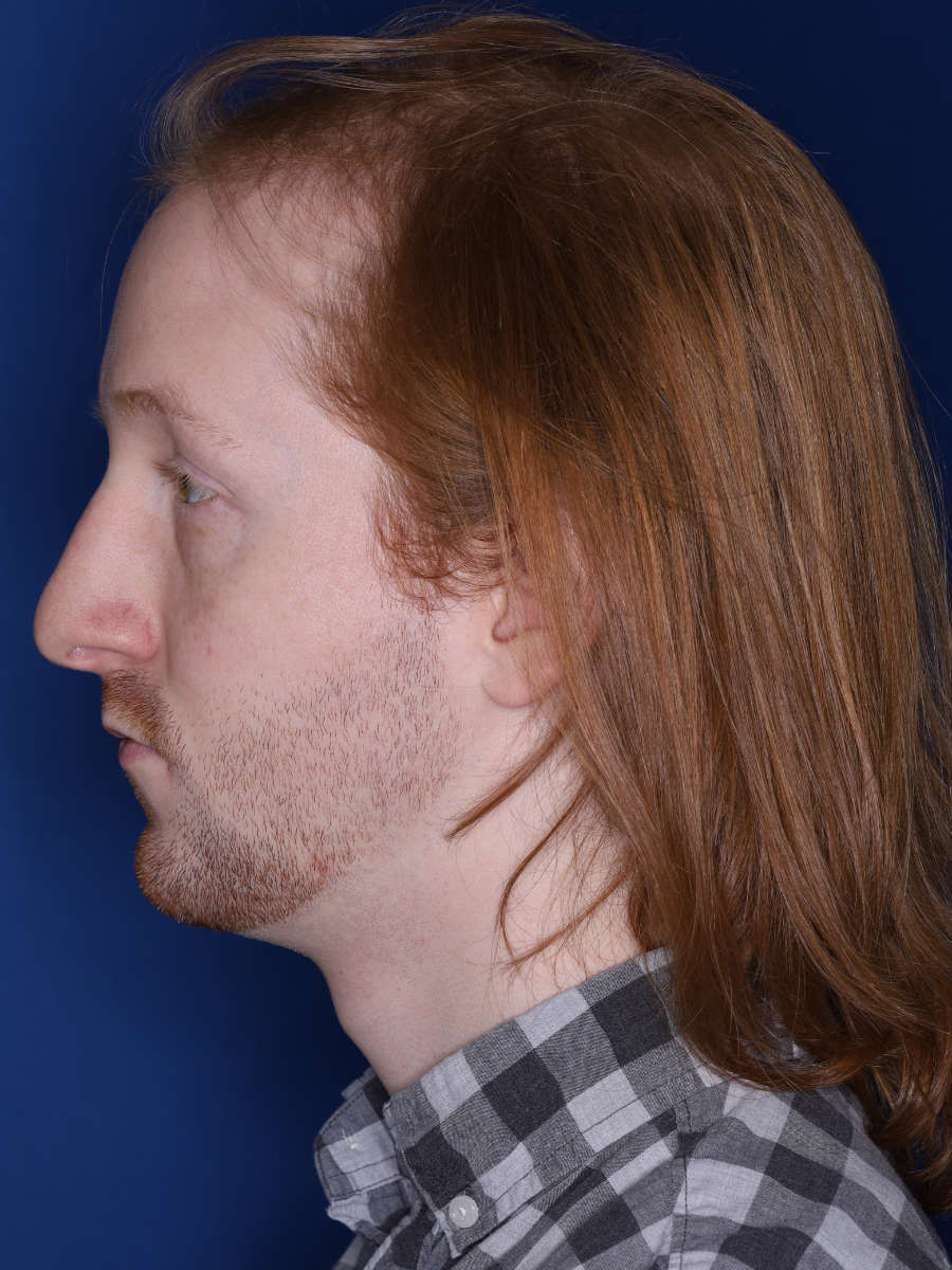 27 year old male 13 months following a 3000 graft hair transplant - b