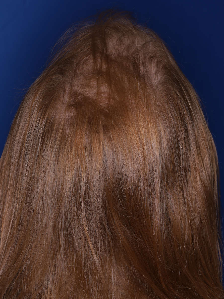27 year old male 13 months following a 3000 graft hair transplant - before