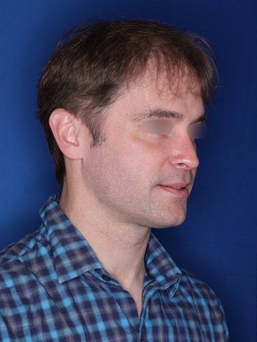 42 year old patient 12 months following 2,500 grafts to restore frontal hairline and mid-scalp