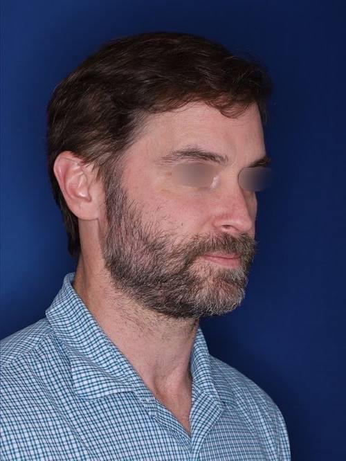 42 year old patient 12 months following 2,500 grafts to restore frontal hairline and mid-scalp