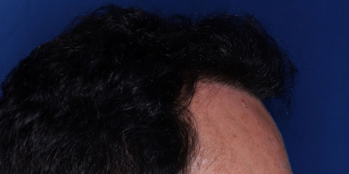 after the hair transplant