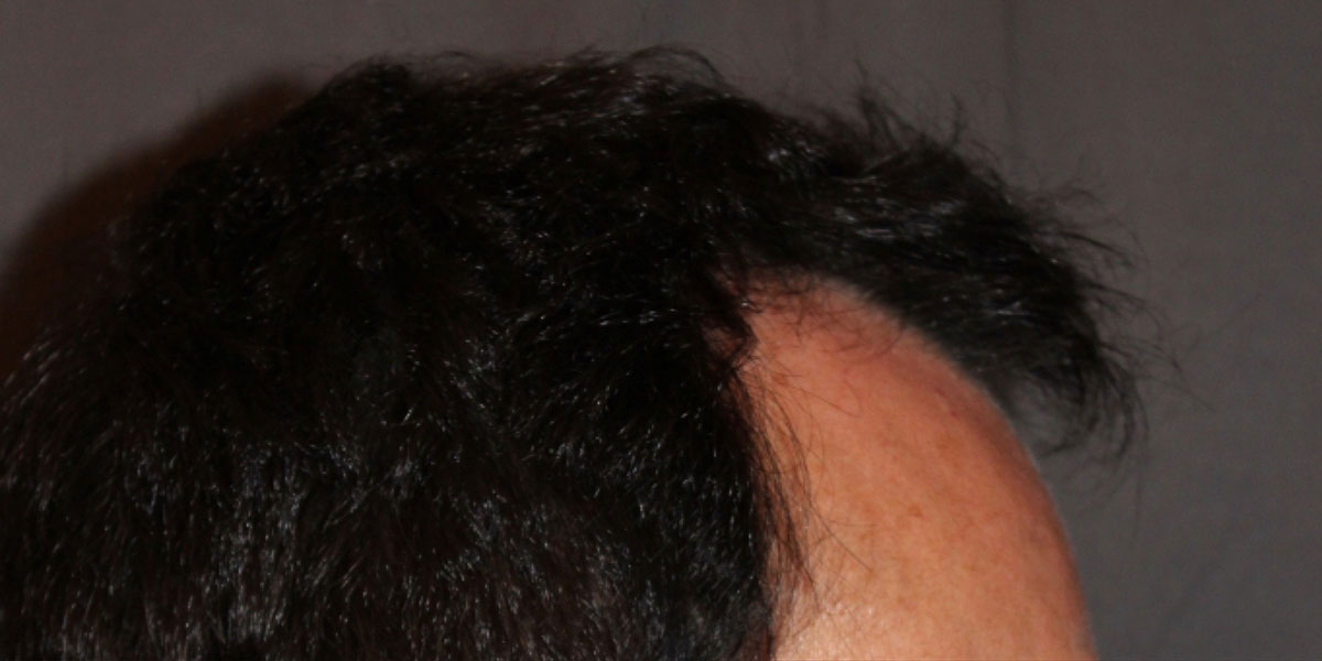 before the hair transplant