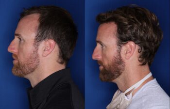 36 year old 8 months following 2500 grafts to frontal, temporal hair line
