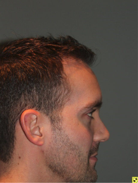 after photo from the left side