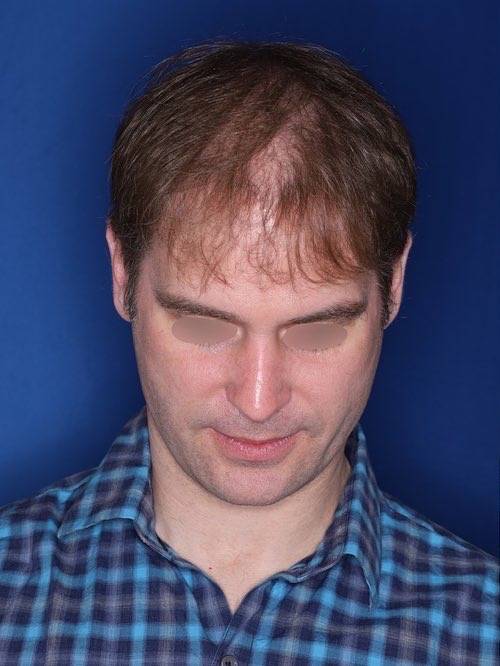 42 year old patient 12 months following 2,500 grafts to restore frontal hairline and mid-scalp
