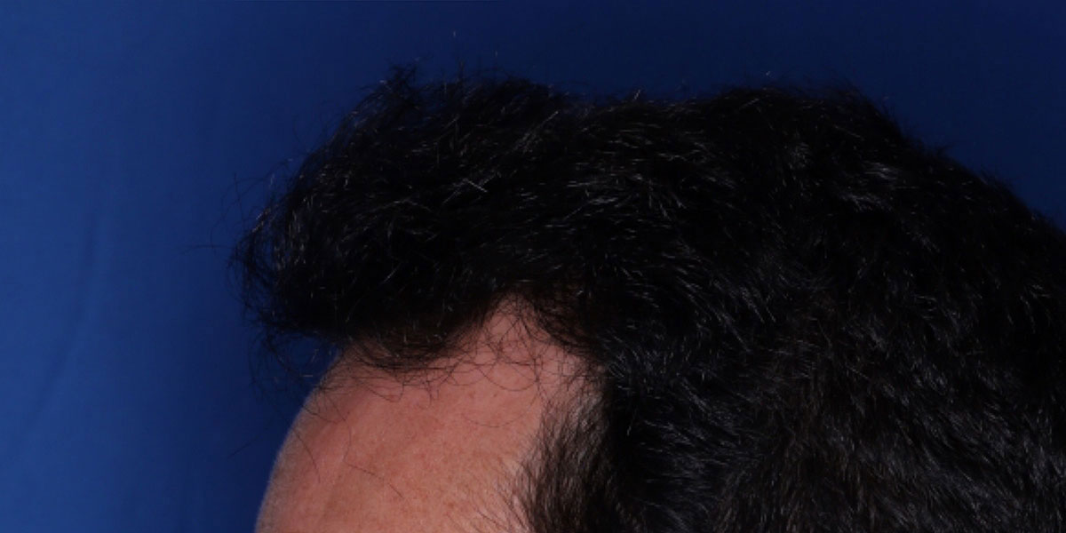 after the hair transplant