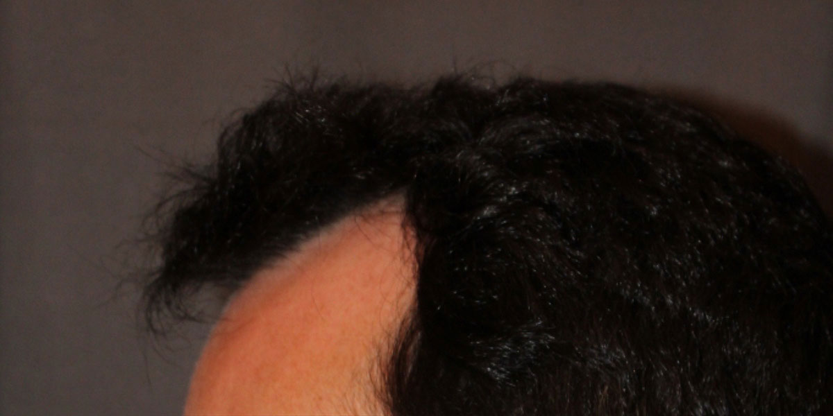 before the hair transplant