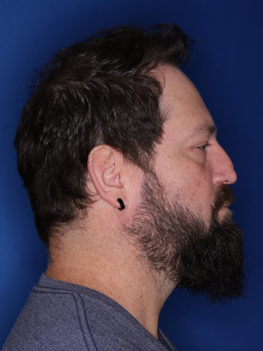 45 year old male 1 year post op from 3000 grafts throughout the entire scalp.