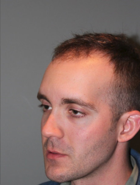 before photo from the left side