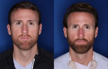 36 year old 8 months following 2500 grafts to frontal, temporal hair line