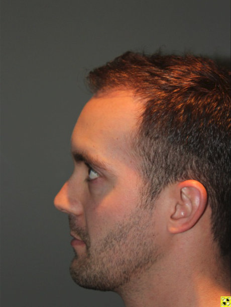 after photo from the left profile