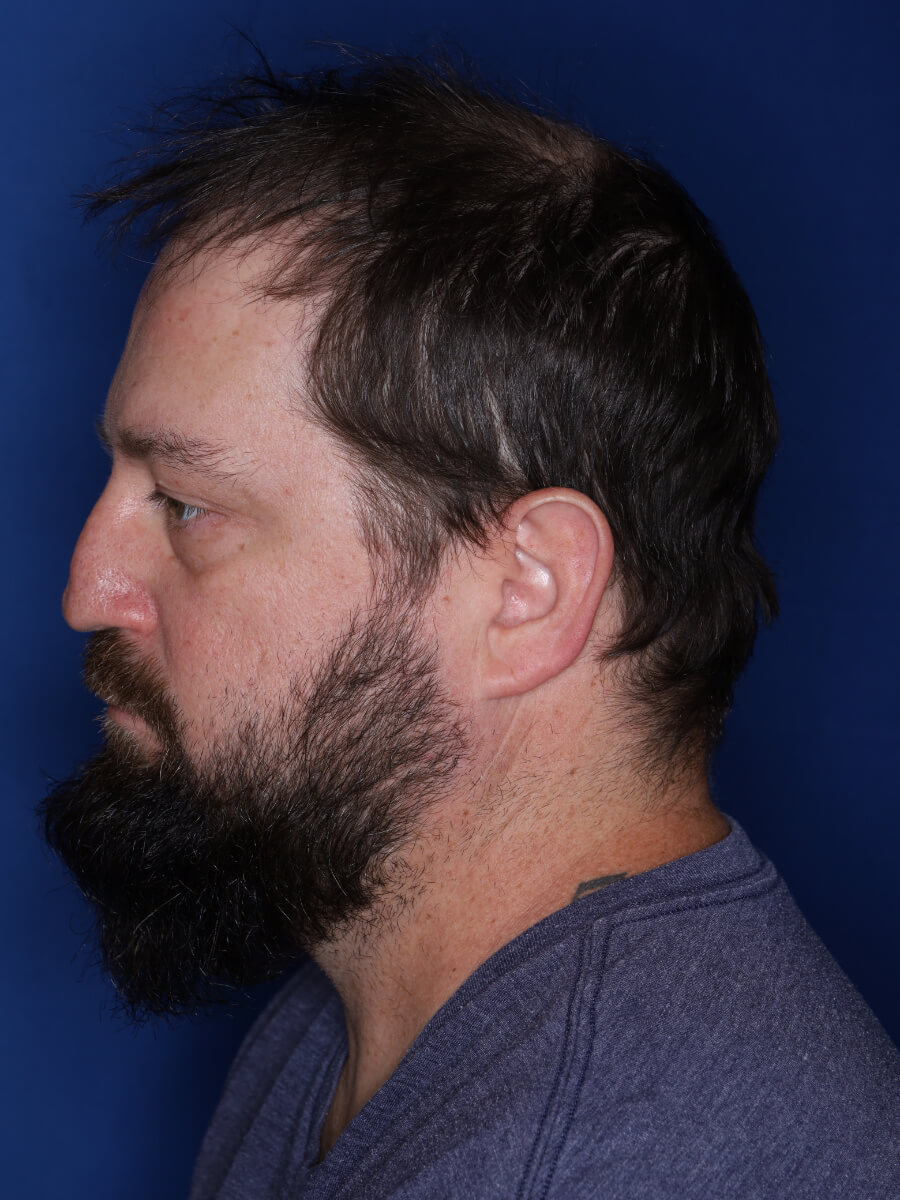 45 year old male 1 year post op from 3000 grafts throughout the entire scalp.