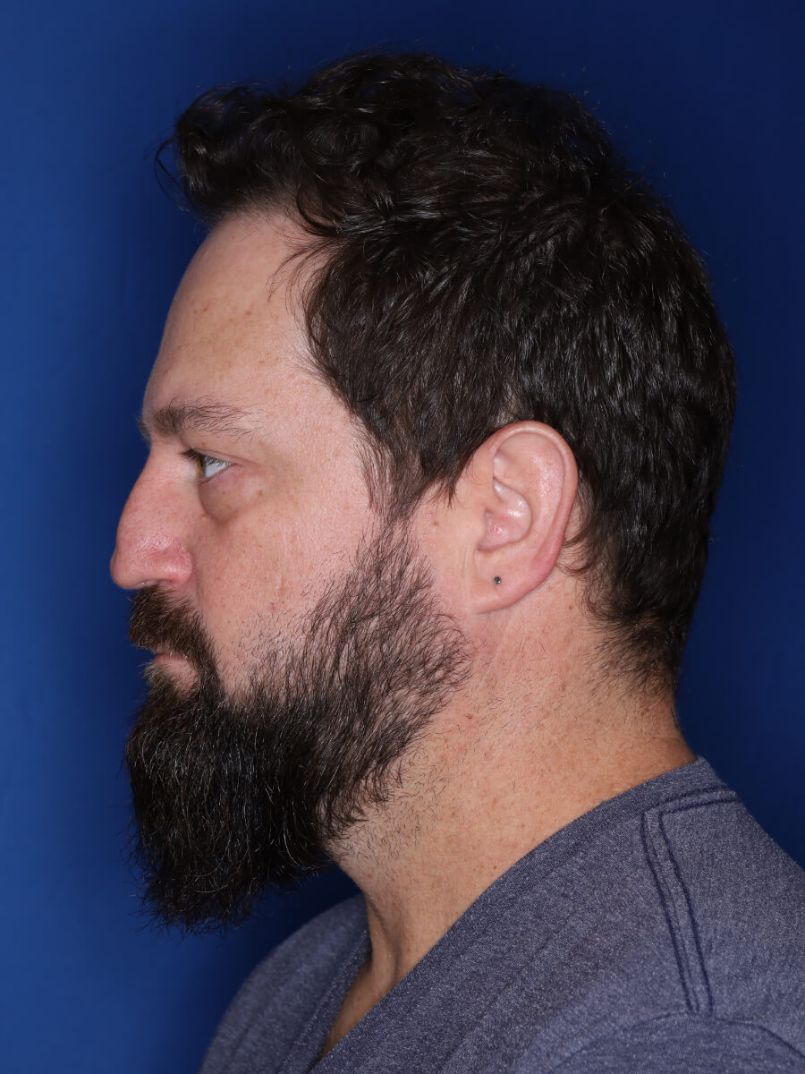 45 year old male 1 year post op from 3000 grafts throughout the entire scalp.
