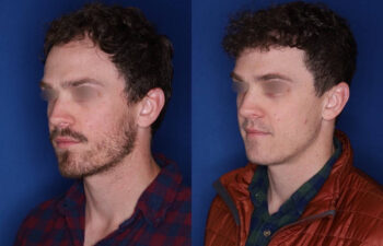 33 yrs old male patient 1+ year post op 2,000 graphs to restore frontal hairline & mid scalp