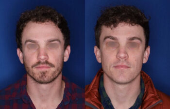 33 yrs old male patient 1+ year post op 2,000 graphs to restore frontal hairline & mid scalp