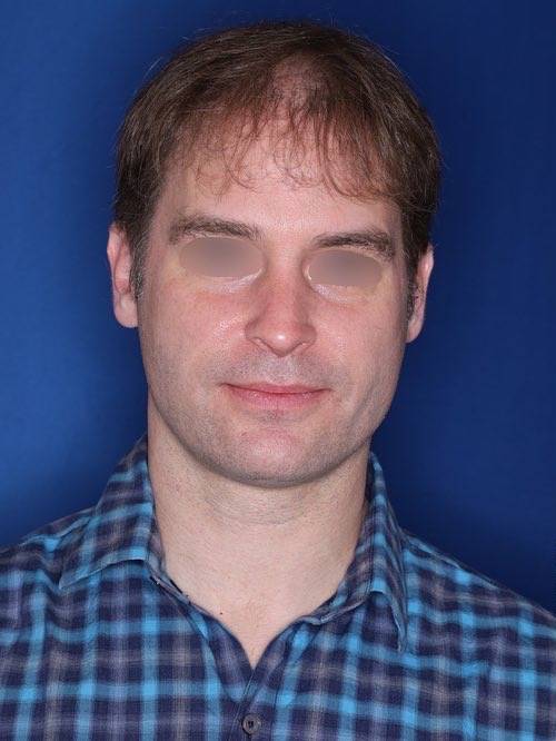 42 year old patient 12 months following 2,500 grafts to restore frontal hairline and mid-scalp