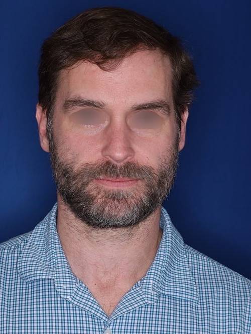 42 year old patient 12 months following 2,500 grafts to restore frontal hairline and mid-scalp