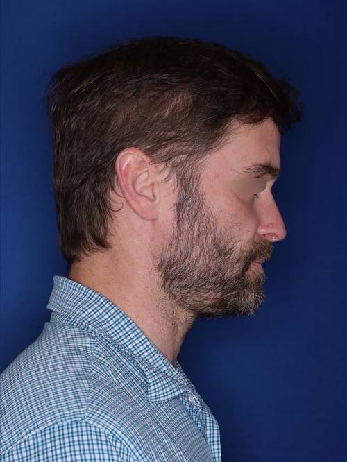 42 year old patient 12 months following 2,500 grafts to restore frontal hairline and mid-scalp