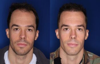 35 year old male 8 months following 2000 grafts to his frontal and temporal areas of hair loss.