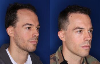 35 year old male 8 months following 2000 grafts to his frontal and temporal areas of hair loss.
