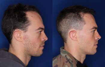 35 year old male 8 months following 2000 grafts to his frontal and temporal areas of hair loss.