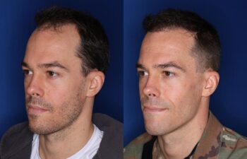 35 year old male 8 months following 2000 grafts to his frontal and temporal areas of hair loss.