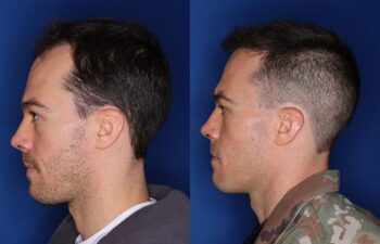 35 year old male 8 months following 2000 grafts to his frontal and temporal areas of hair loss.