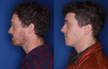 33 yrs old male patient 1+ year post op 2,000 graphs to restore frontal hairline & mid scalp