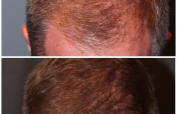 34 year old male 7 months post 2000 graft frontal hairline hair transplant. About 60% regrowth of what he will have at 18 months.