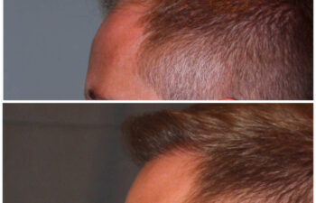 34 year old male 7 months post 2000 graft frontal hairline hair transplant. About 60% regrowth of what he will have at 18 months.