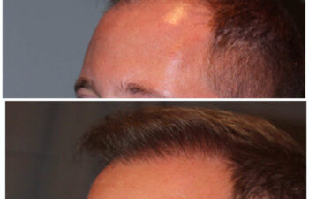 34 year old male 7 months post 2000 graft frontal hairline hair transplant. About 60% regrowth of what he will have at 18 months.