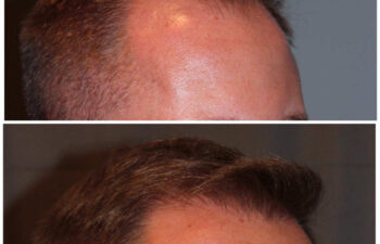 34 year old male 7 months post 2000 graft frontal hairline hair transplant. About 60% regrowth of what he will have at 18 months.